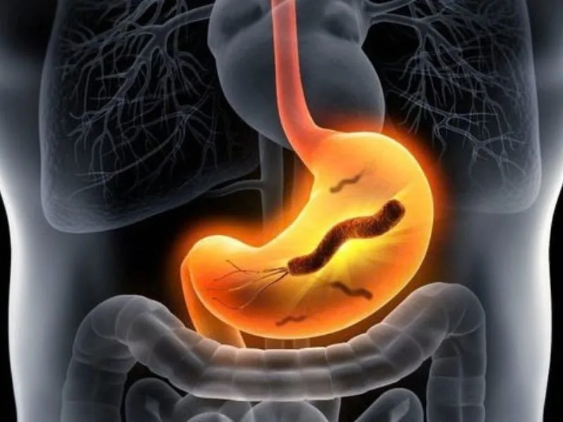 HP dạ dày là gì? HIỂU ĐÚNG về vi khuẩn Helicobacter pylori